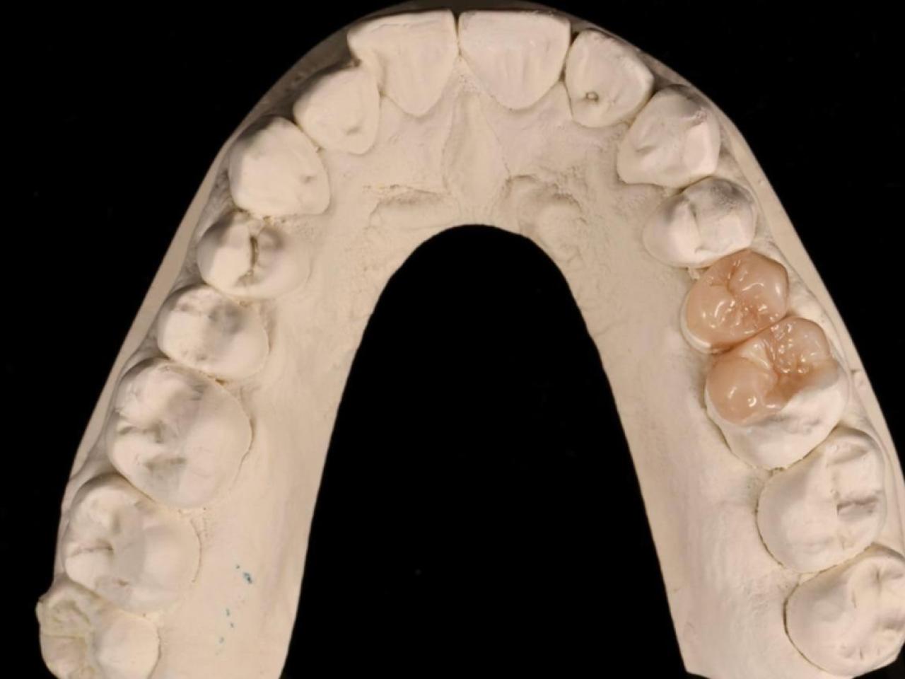 Protetică modernă - Fiecare restaurare protetică este concepută ca parte dintr-un ansamblu armonios, care respectă atât estetica zâmbetului, cât și echilibrul funcțional al întregii danturi.