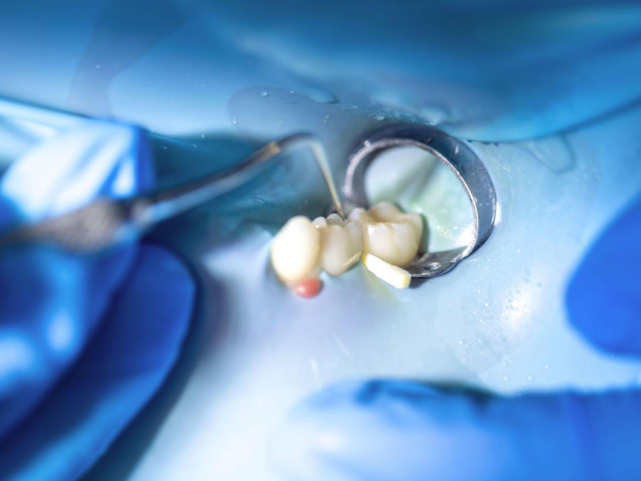 Restaurări complexe - Refacem dinții compromiși și redăm funcționalitatea lor naturală.